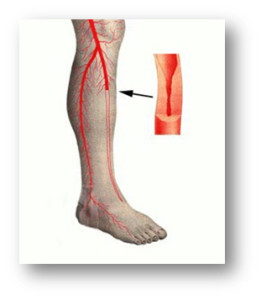 lábak érrendszeri betegség tünetei és a kezelés