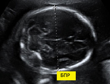 BDP - ez biparietal fej mérettáblázatában hétig