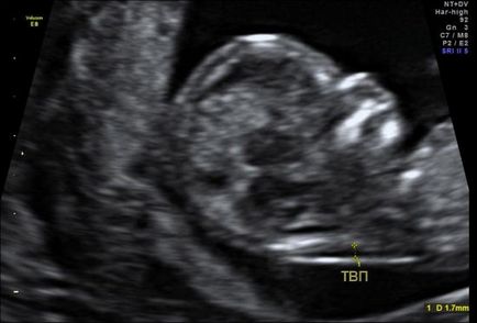 Mi a CTE, BPV, TVP magzatot terhességi ultrahang