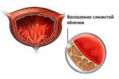 Cystitis vérrel vizelés közben okok és a kezelés