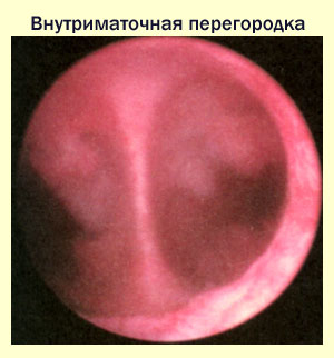 Diagnózis septum a méhben