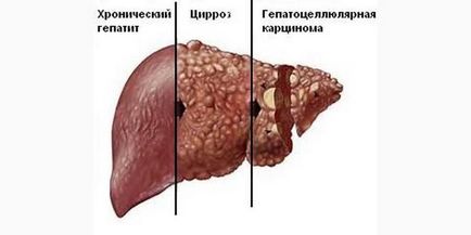 Hol és hogyan fáj a májat, és mit kell tennie, hogy a tünetek kezelésére, tünetek