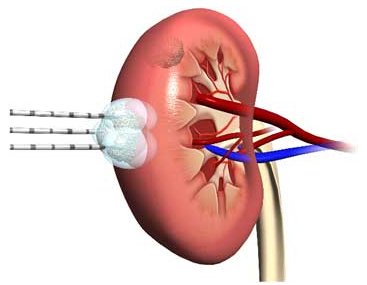 Hyperechoic zárványok a vesében típusú, a tünetek, a kezelés Hyperechoic zárványok a vesében típusú, a tünetek, a kezelés
