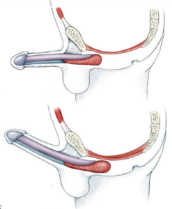 Hogyan kell helyesen legyen a pénisz, merevedés egészséges - a pénisz, a talpán, megelőzés