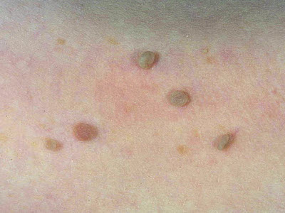 Hogyan kell kezelni papillomavírus alap kezelések és módjait fertőzés papilloma vírus (HPV) (kezelni az embereket, ahogy papillomavírus terjedő fertőzés HPV papillomavírus) Hogyan kell kezelni papillomavírus főbb kezelési módszereket és az utat a vírusfertőzés papillomavírus (HPV)