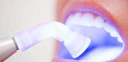 Hogyan fehéríti a fogakat otthon károsodás nélkül - a fő módja