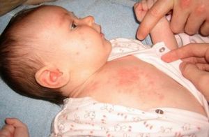 Hogy allergiás a por csecsemők