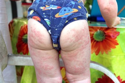 Hogyan működik egy allergia mosópor a baba fotó és tünetek