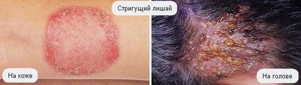 Mi zsindelyeink fotók emberi betegségek (humán) tünetei Mi zsindelyeink fotók emberi betegség tünetei