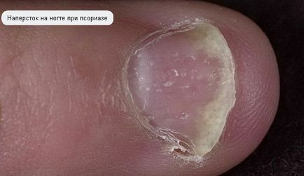 Mi zsindelyeink fotók emberi tünetek (fajta zuzmó) Mi zsindelyeink fotók emberi betegség tünetei