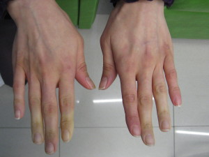 Hogyan Cure-szindróma harapós ujjvégek műtét nélkül