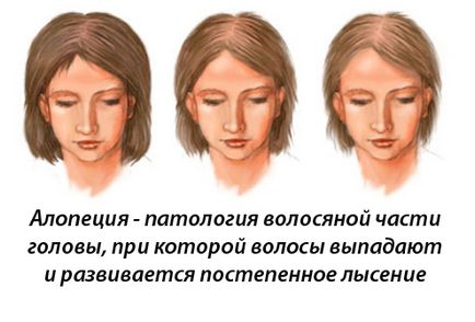 alopecia kezelés - orvosi portál EUROLAB