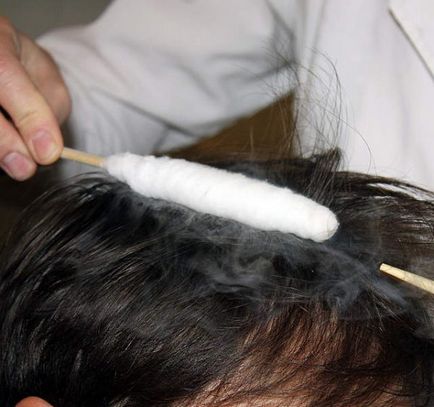 Kopaszság kezelésére férfiaknál diagnózis és hatékony módszerekkel foglalkozó alopecia