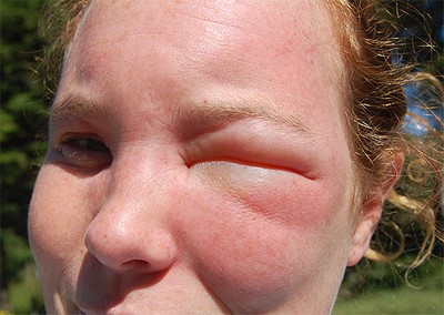szem ödéma kezelés, mi a teendő, ha egy allergiás duzzanat és bőrpír