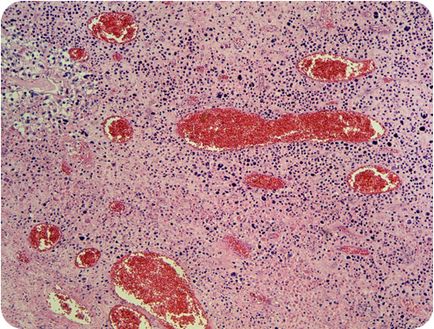 A kezelés a vasculitis - orvosi portál EUROLAB (vasculitis) vasculitis kezelésére - orvosi portál EUROLAB