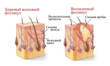 Cure hajhullás - gyógyszerek balzsam, spray, kenőcs, krém hajhullás ellen