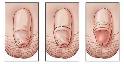 Medportal - Körülmetélés minden - - és - szemben