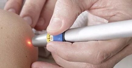 Lehetséges, hogy távolítsa el papilloma a test, és hogy meg kell csinálni (a test) Lehetséges, hogy távolítsa el papilloma a test és attól, hogy az ehhez szükséges