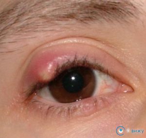 Duzzadt szemek (allergia miatt, duzzadt szemhéj, nagyon duzzadt a szem körül és a szem), mit kell tenni