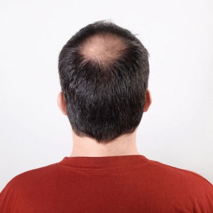 A fő okok és kezelések hajhullás a férfiak
