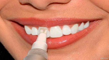 Fehéríti fogait otthon veszélytelen hagyományos és modern módszerek