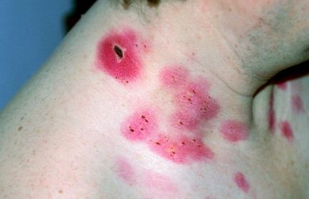 Humán papillomavírus - a tüneteket, megelőzésére, kezelésére
