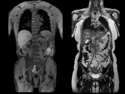 Előkészítése MRI a hasüreg és szerveiben való peritoneális tér