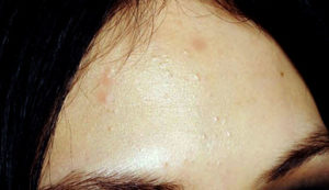 Bőr alá pattanások a homlokon okoz, és hogyan lehet megszabadulni a pattanások belső