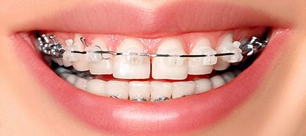 Hogyan fogszabályozó viselése a fogát