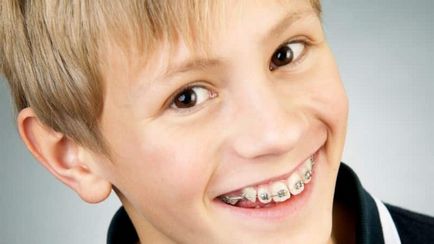 Hogyan fogszabályozó viselése a fogakra, hogy összehangolják a fogak