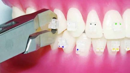 Hogyan fogszabályozó viselése a fogakra, hogy összehangolják a fogak