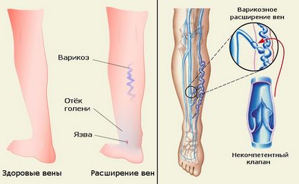 láb vérerek (alsó végtag) mik a betegségek, tünetek és a kezelés