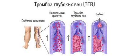 láb vérerek (alsó végtag) mik a betegségek, tünetek és a kezelés