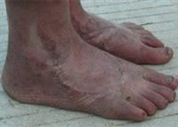 Érrendszeri lábak tünetek, problémák