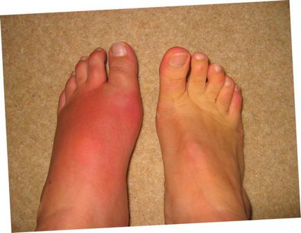Érrendszeri láb betegség típusok, tünetek, okok, kezelés