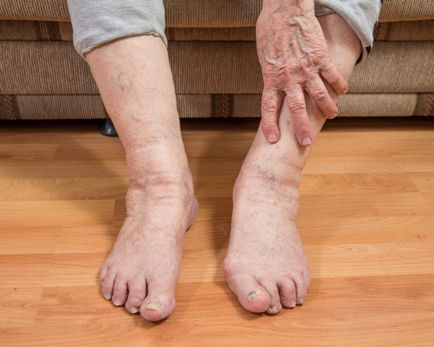 Érrendszeri láb betegség típusok, tünetek, okok, kezelés