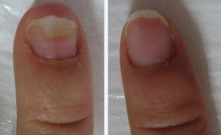 Tippek Elena Malysheva hogyan gyógyítja gomba láb és a körmök az elmúlt hónapban