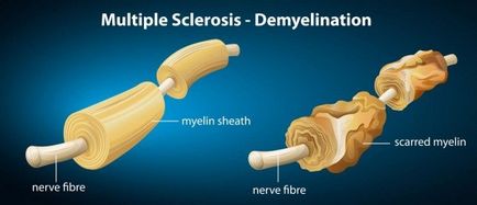 Módszerek sclerosis multiplex kezelésére népi jogorvoslati és módszerek - gyógynövények és díjak, olaj és zsír,