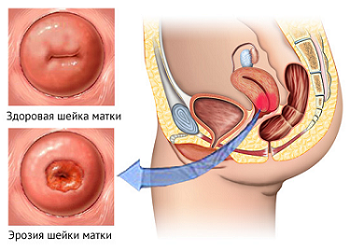 douching nőgyógyászati