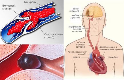 Vérrögök a szervezetben okoz, a tünetek, a kezelés