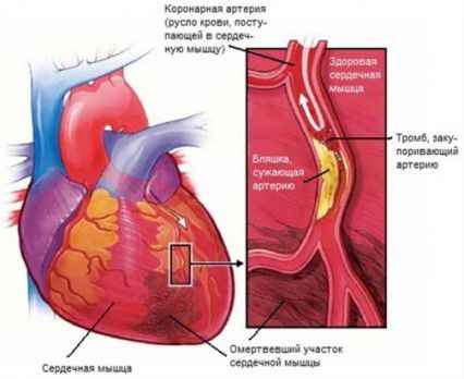 Thrombosis, vérrögképződés, trombózis - megelőzésére és kezelésére