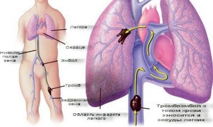 Thrombosis, vérrögképződés, trombózis - megelőzésére és kezelésére