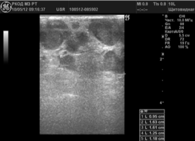 Ultrahang diagnosztika rosszindulatú elváltozások a perifériás nyirokcsomókban -