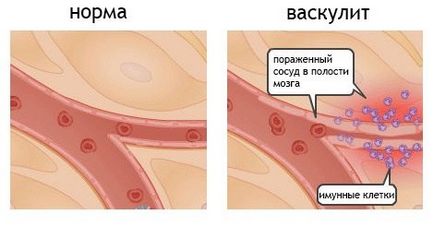 Vasculitis - azaz, az okok, tünetek és a kezelés