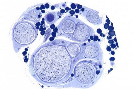 Vasculitis - mi ez, és okoz tüneteket vasculitis