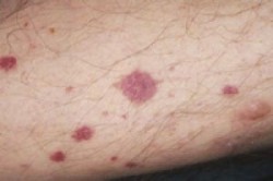 Vasculitis tünetek kezelésére népi jogorvoslati otthon