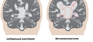 Ventriculomegalia a magzat és az újszülött gyermek, mi az, okok, kezelés, következményei