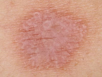 Típusai megfosztja a bőrt, a kezek és emberi test - fotó, tünetek és kezelés