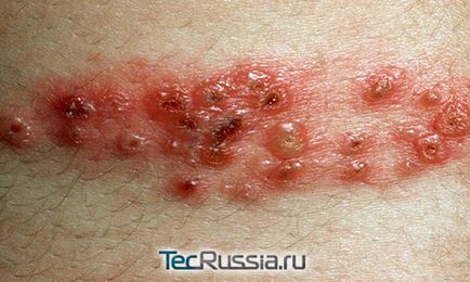 Típusai megfosztja a bőrt, a kezek és emberi test - fotó, tünetek és kezelés
