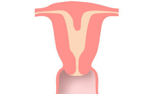 Méhen belüli válaszfal terhesség alatt